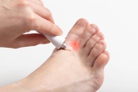 All You Need to Know About Athlete’s Foot