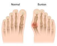 Types of Bunions