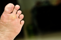 What Symptoms are Associated With a Foot Corn?