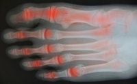 Managing Foot Arthritis