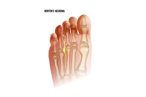A Podiatrist’s Approach to Relief for Morton’s Neuroma