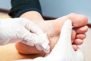 What Does a Plantar Wart Look Like?