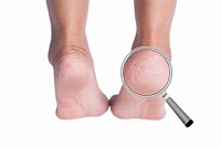 Cracked Heel Infections